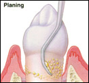 Example of root planing